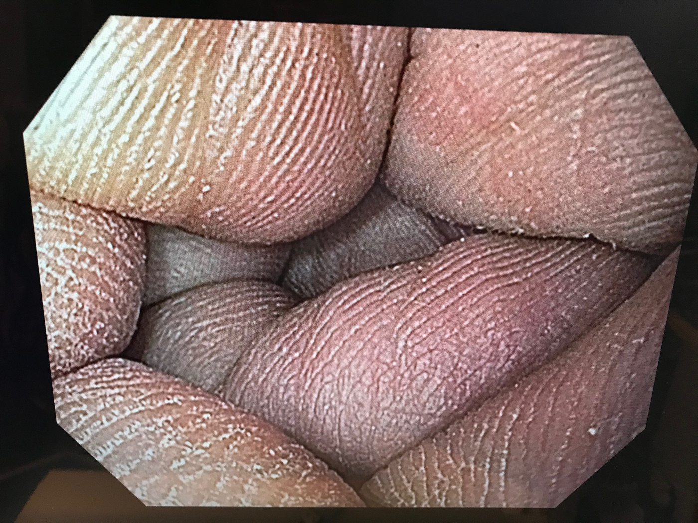 Olympus GIF-H170 Gastroscopy